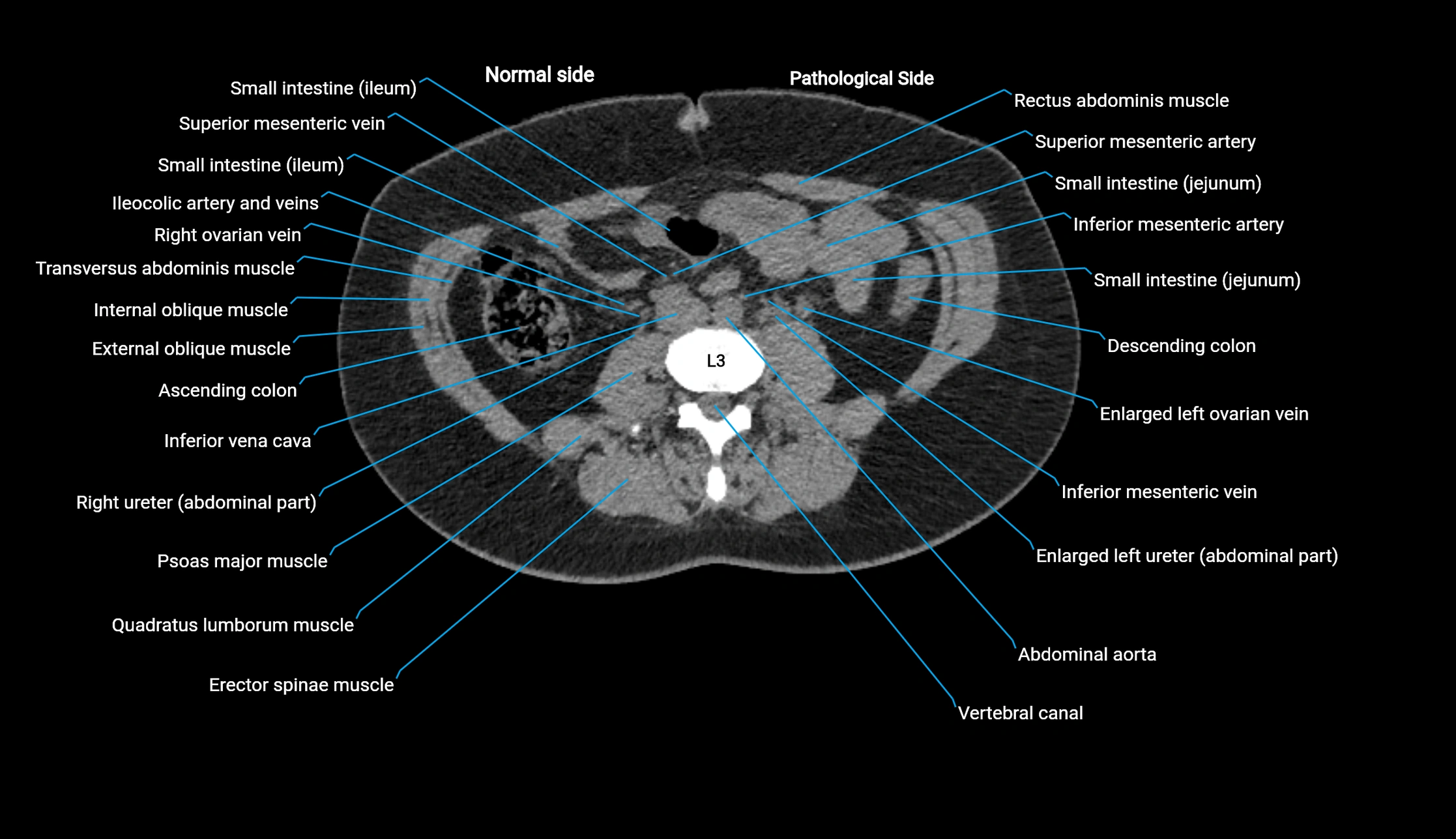 CT KUB axial cross sectional anatomy  radiology image -img-00201-00076.webp